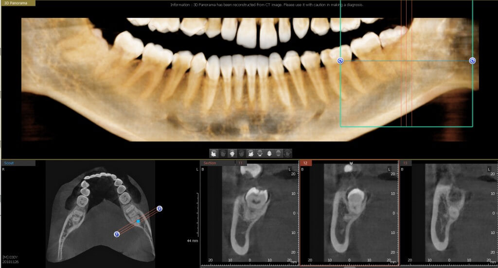 3D fogászati CT